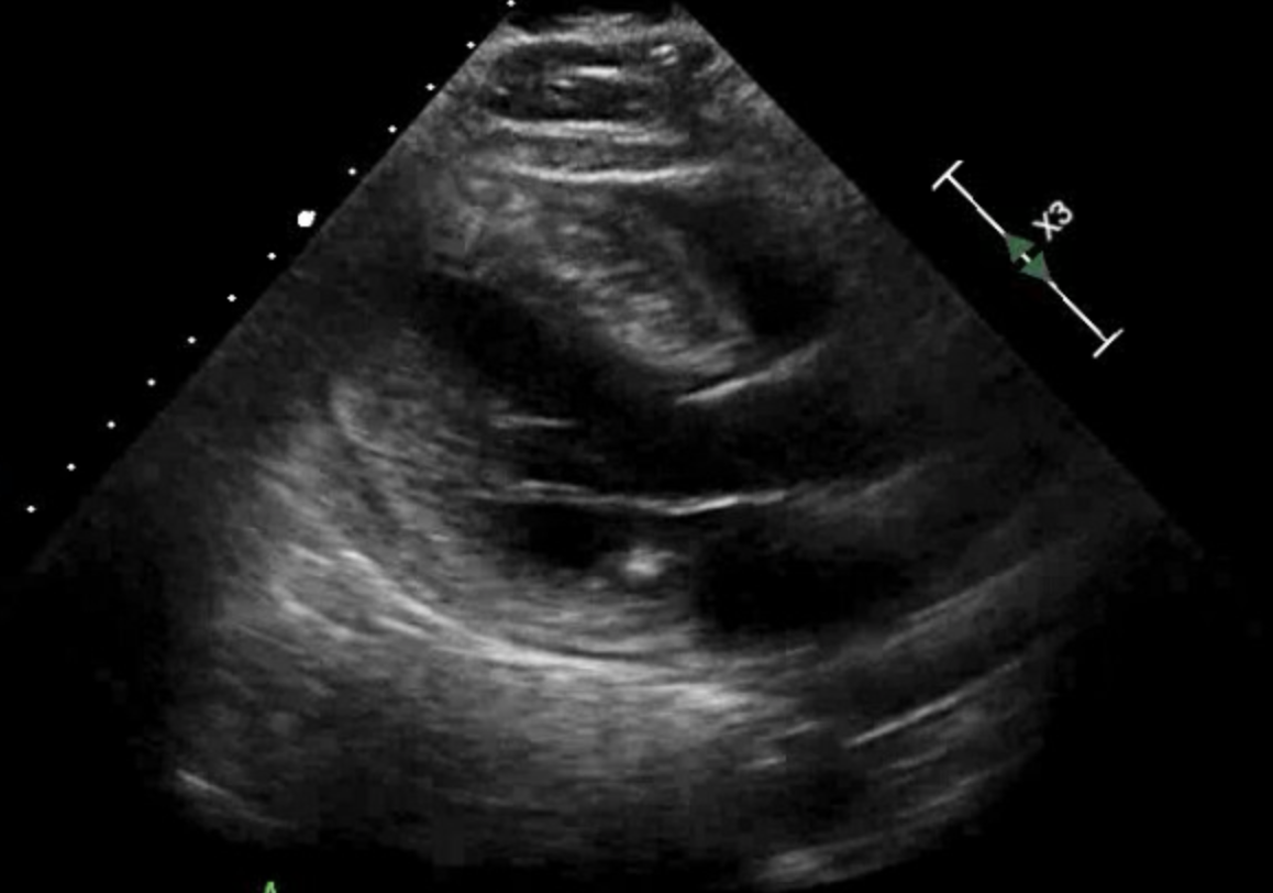 <p>Hypertrophic Cardiomyopathy, Echocardiogram