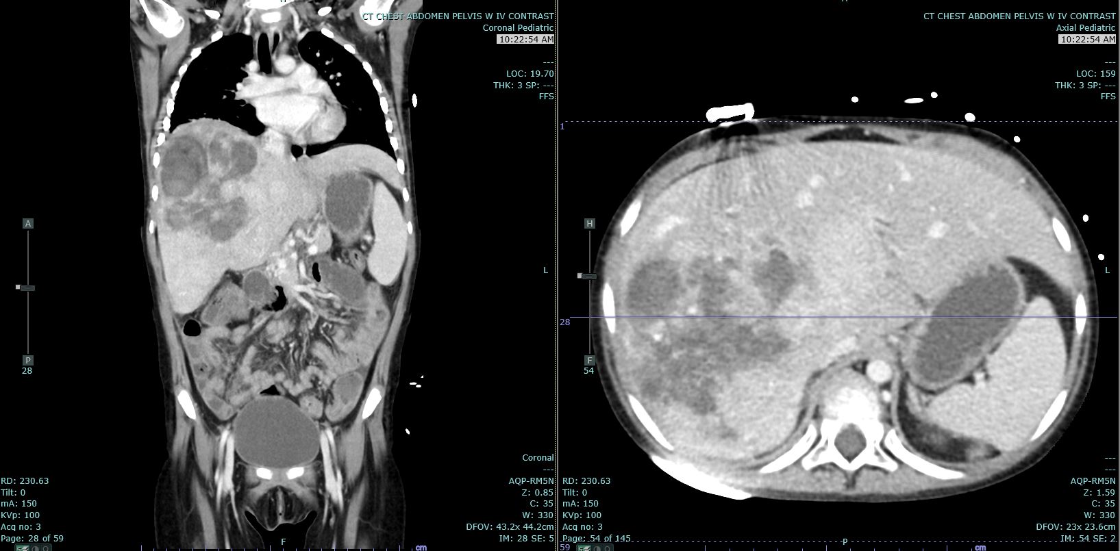 Hepatoblastoma