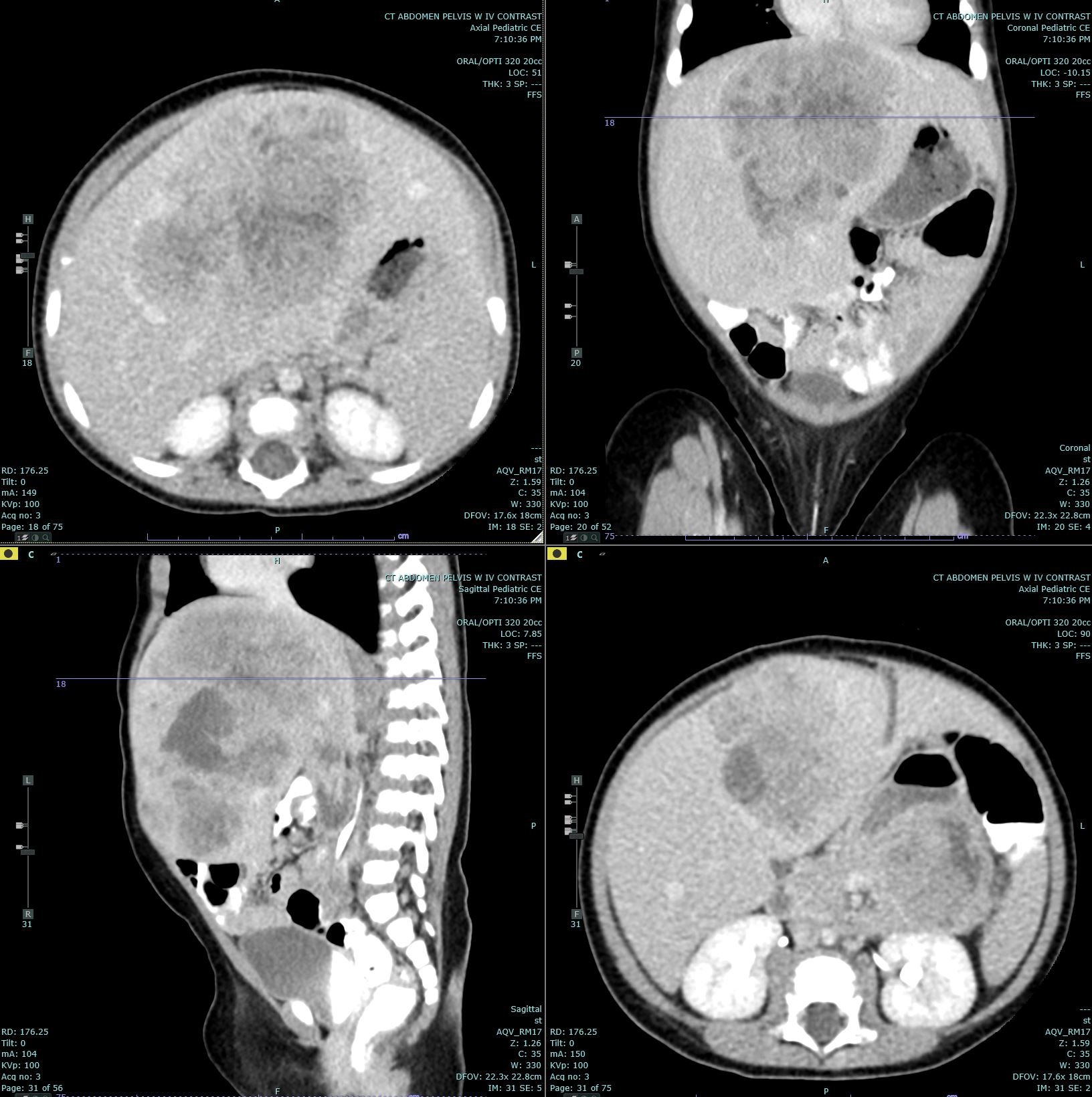 Hepatoblastoma