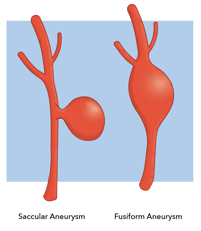 Berry Aneurysm