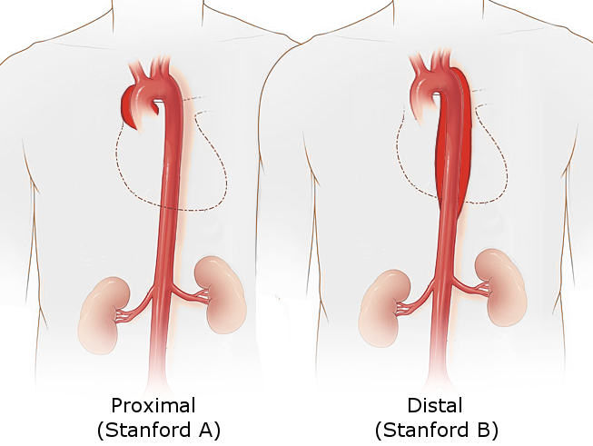 Stanford classification of aortic dissection.