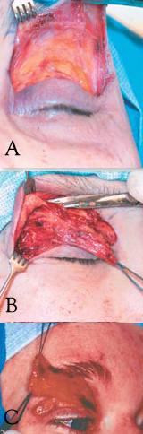 <p>Limited Myectomy for Blepharospasm