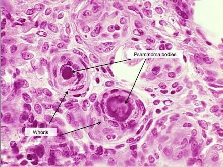 Psammoma bodies