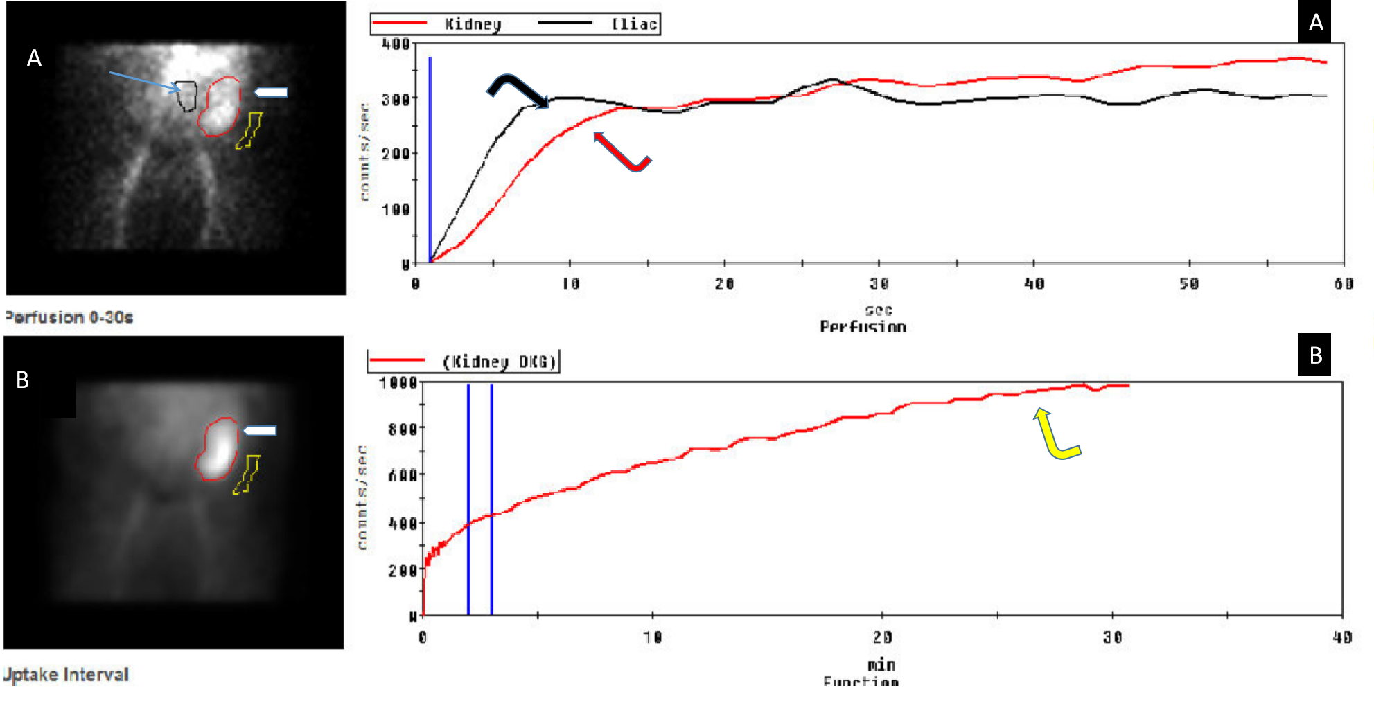 99Tcm-Mag3 renal scan: Abnormal transplant due to acute tubular necrosis (ATN)