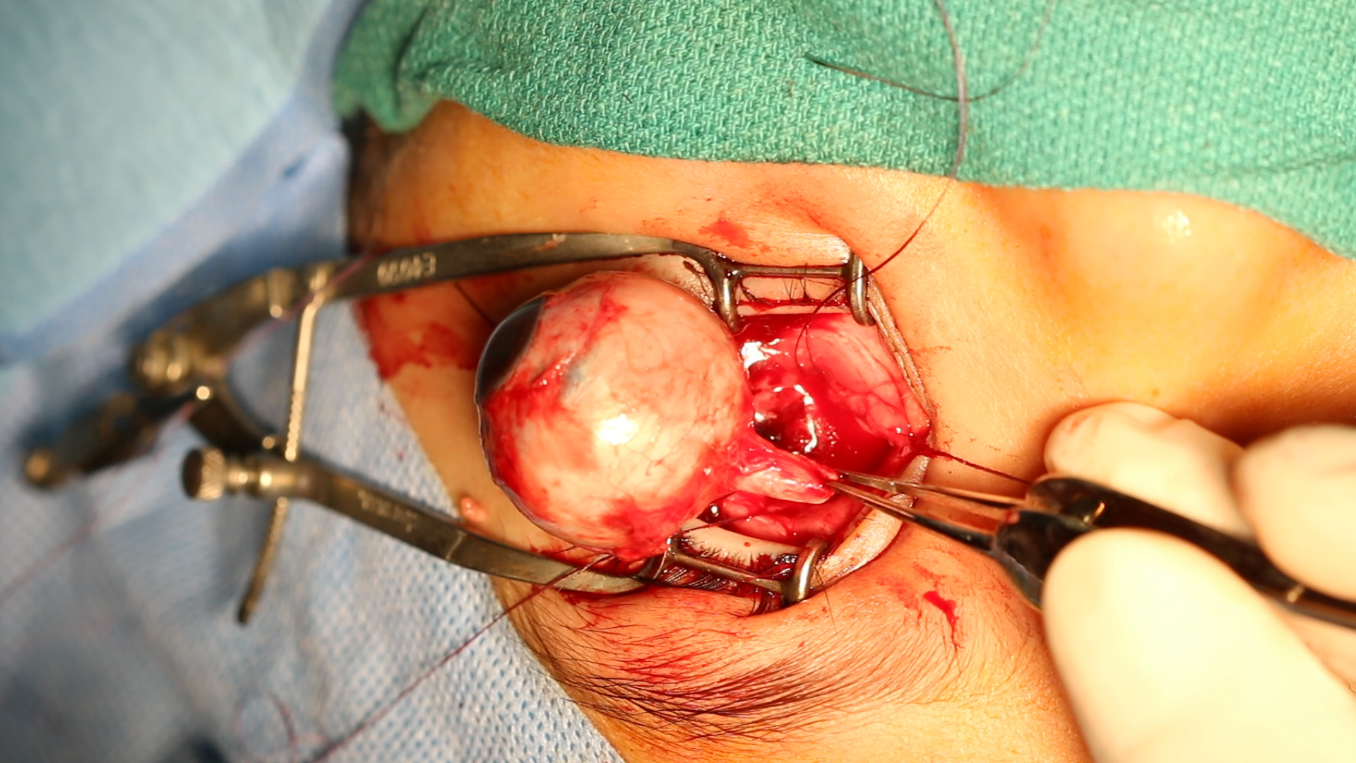 Enucleation: by using the separate supers-medial approach to the optic nerve, a good length of the optic nerve can be obtained as seen here