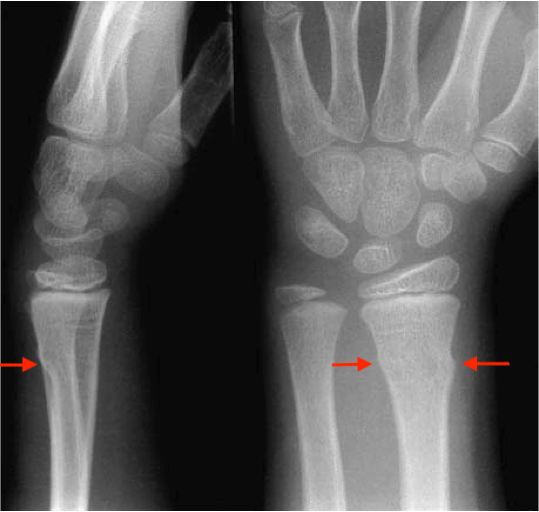 Buckle fracture of distal radius.