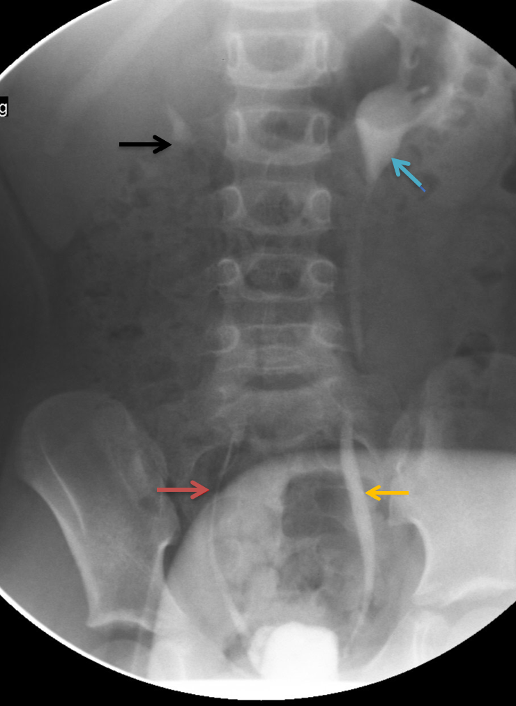 <p>Fluoroscopic Spot Image Revealing Bilateral VUR on VCUG