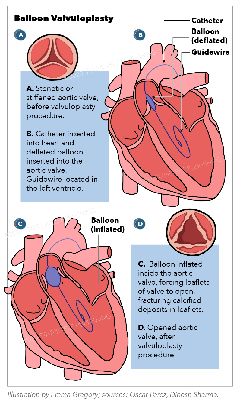 Graphic showing Balloon Valvuloplasty