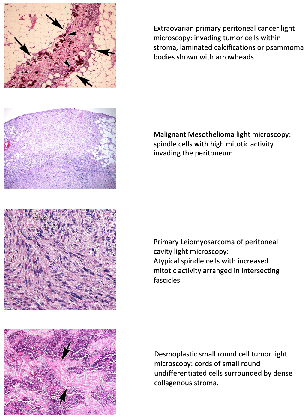 PMID 18349460  and 28287938 Light Microscopic features of different types of Peritoneal Cancer.