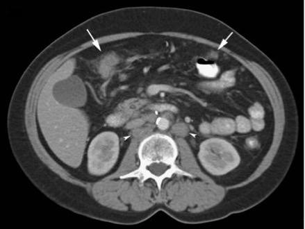 PMID 22347961 CT scan image showing infiltration and nodularity of peritoneum with formation of 'omental cakes' and lymphadenopathy