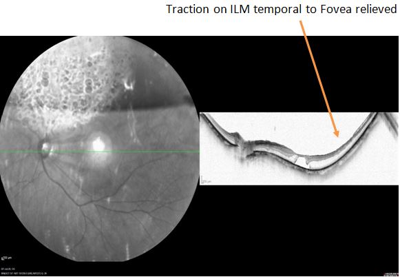 <p>Relieved Traction on the ILM After Surgery. OCT depicting relieved traction on the ILM after the surgery.</p>