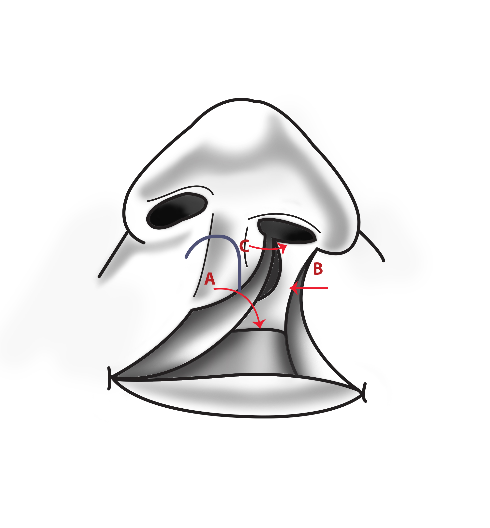 Figure 3. Millard rotation-advancement technique flaps.