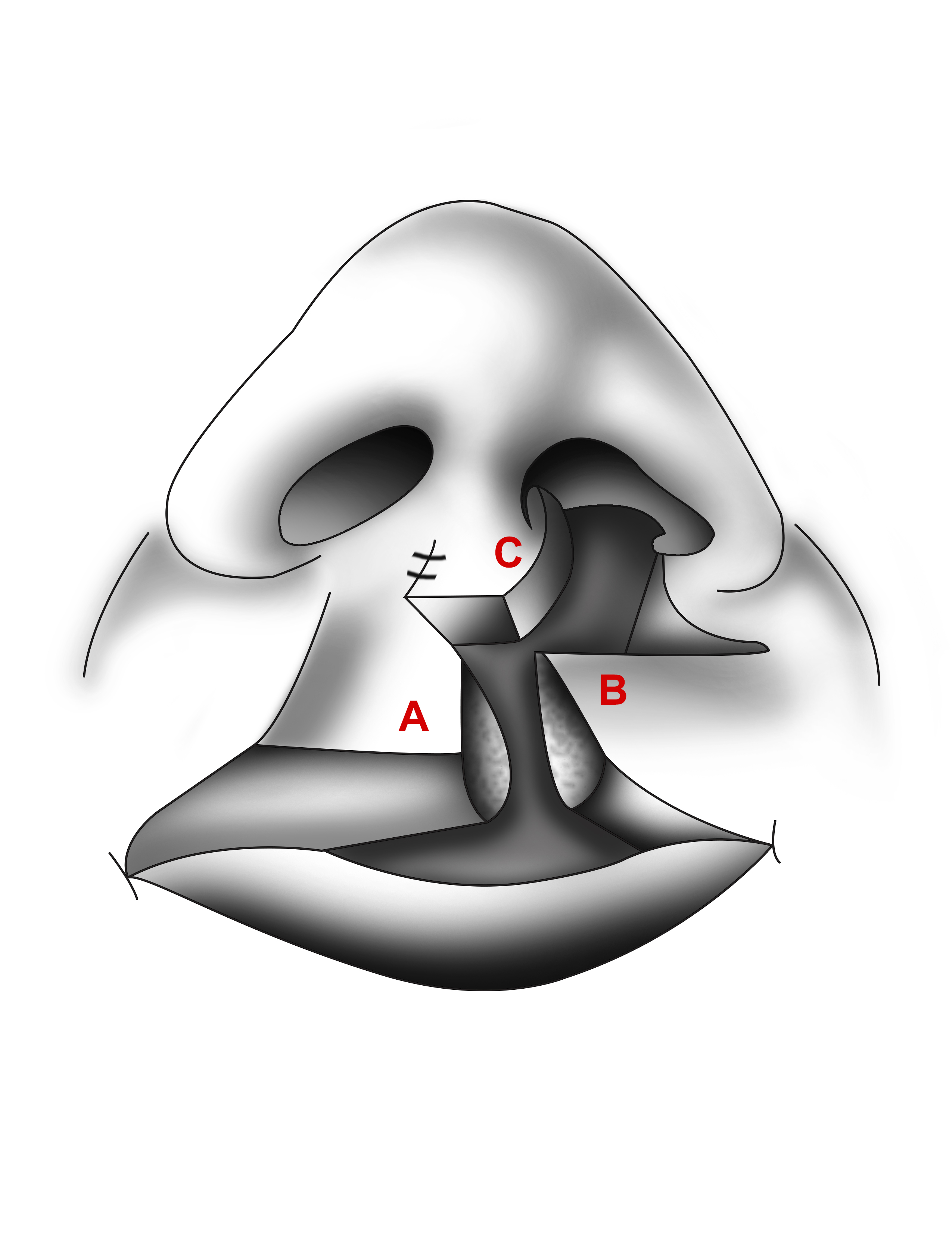 Figure 4. Millard rotation-advancement technique with c-flap sutured for columellar lengthening.