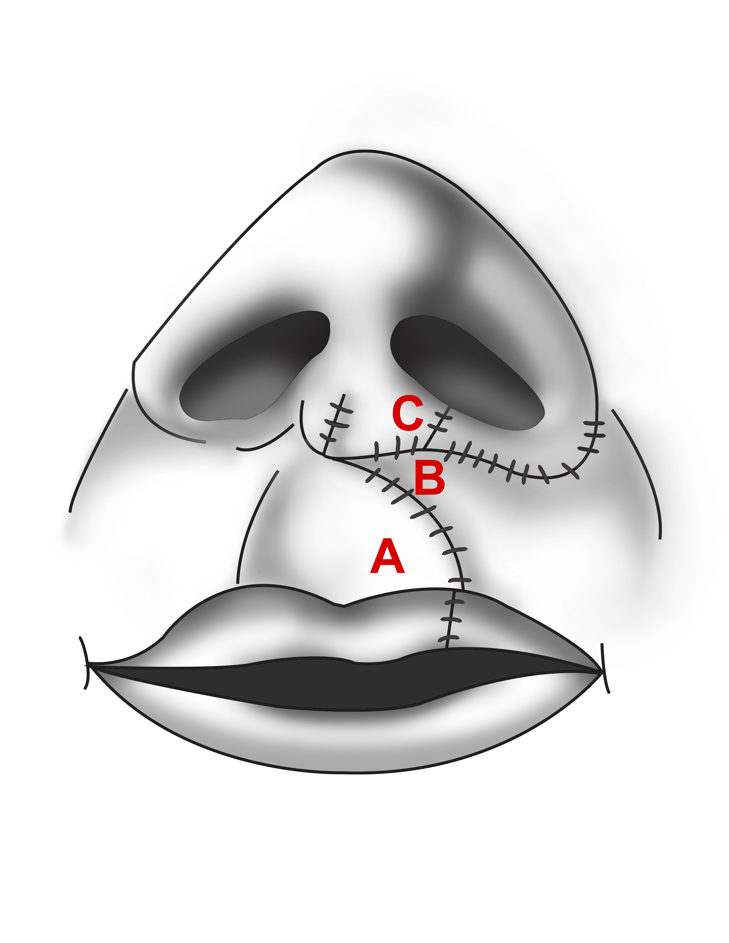 Figure 5. Millard rotation-advancement technique.