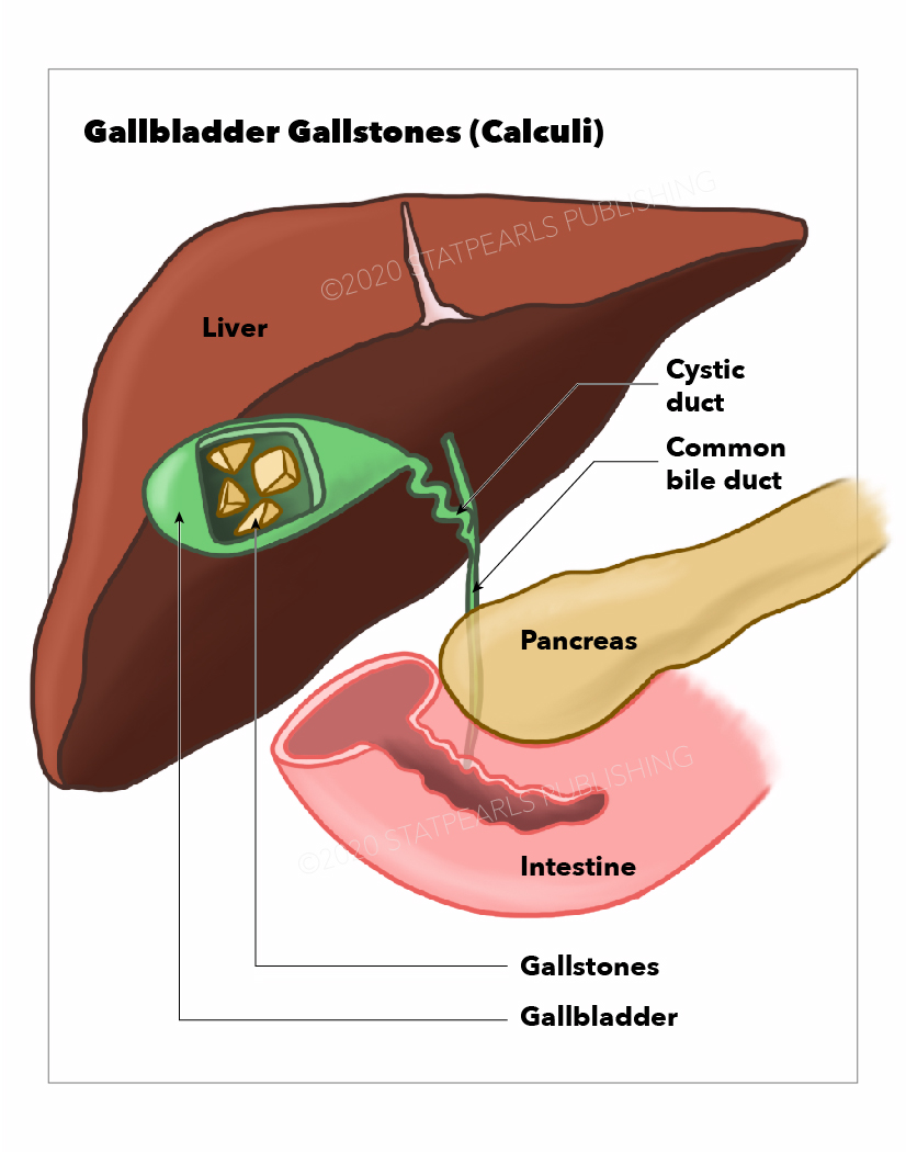 Gallbladder Gallstones (Calculi), Common 
bile duct, Pancreas, Intestine, Gallbladder, Gallstones, Liver