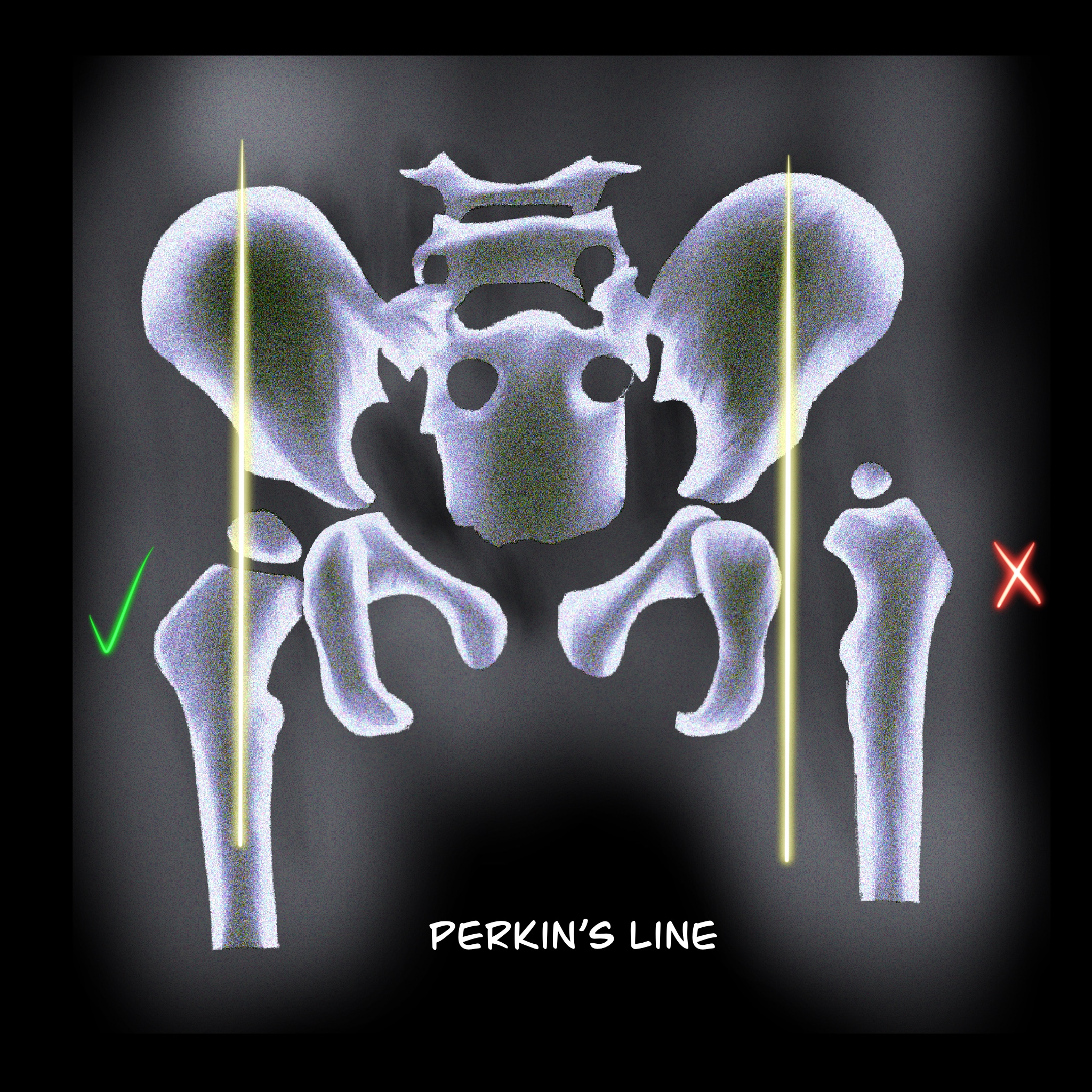 Figure 2: Perkin´s line. The femoral head should be medial to this line.