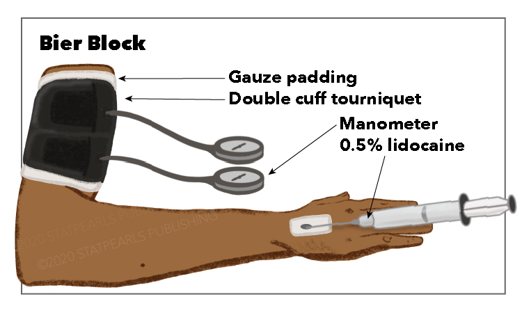 Bier Block, Gause padding, double cuff tourniquet, manometer, lidocaine