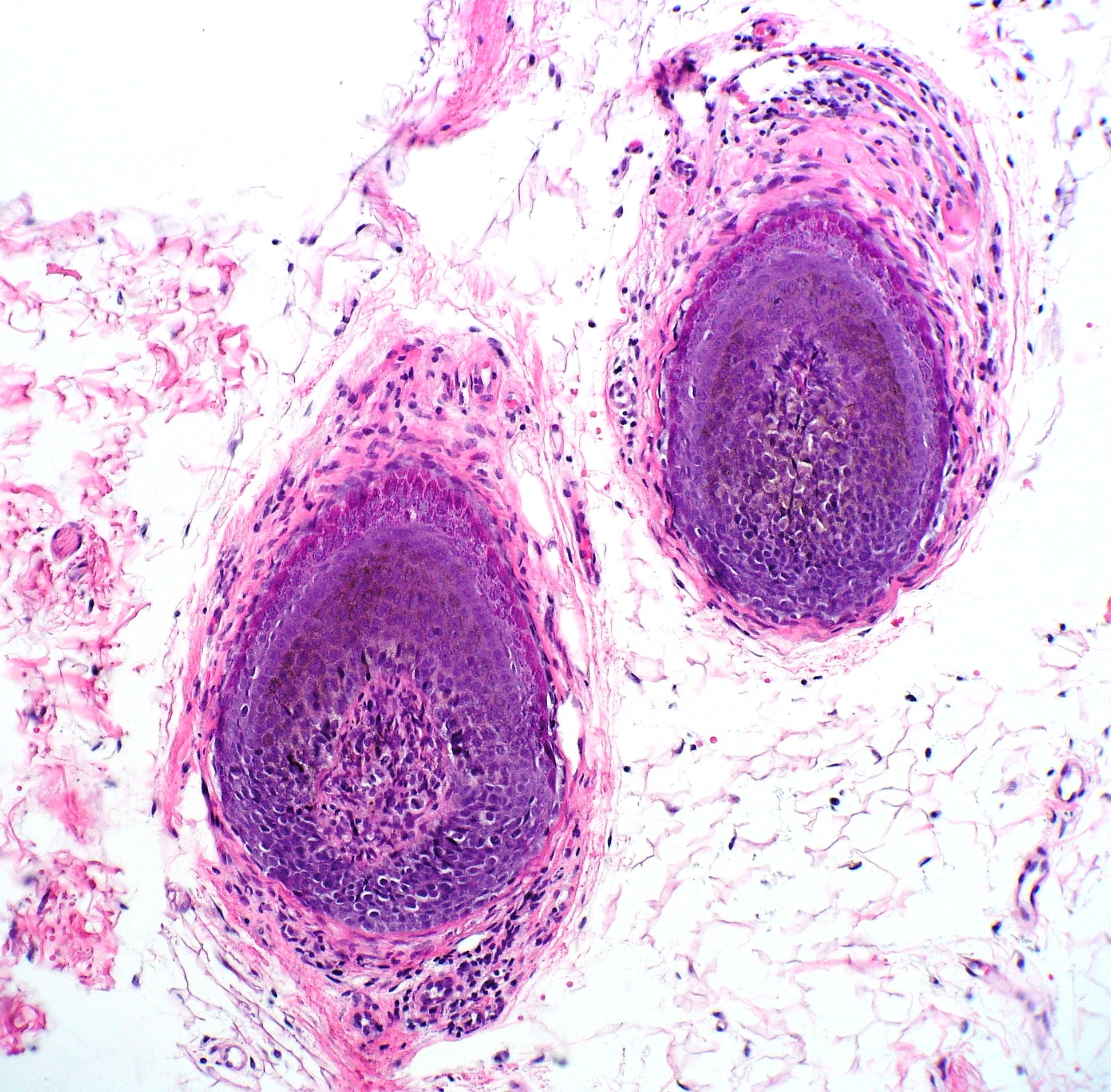 <p>Alopecia Areata Biopsy