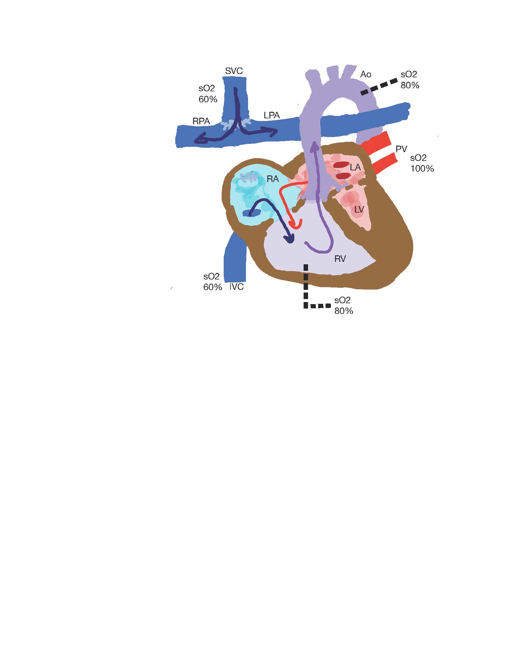 <p>Superior Cavopulmonary Anastomosis</p>