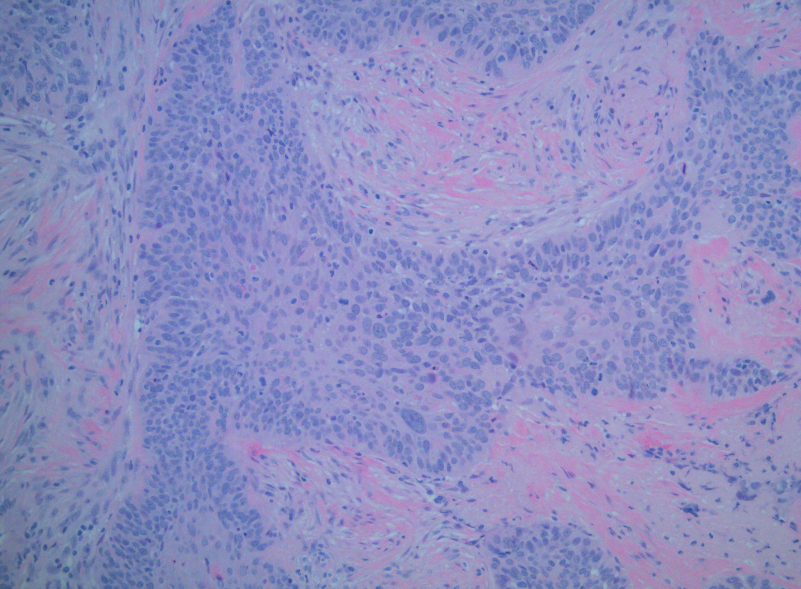 <p>Squamous Cell Carcinoma of the Palate Without P16 Staining</p>