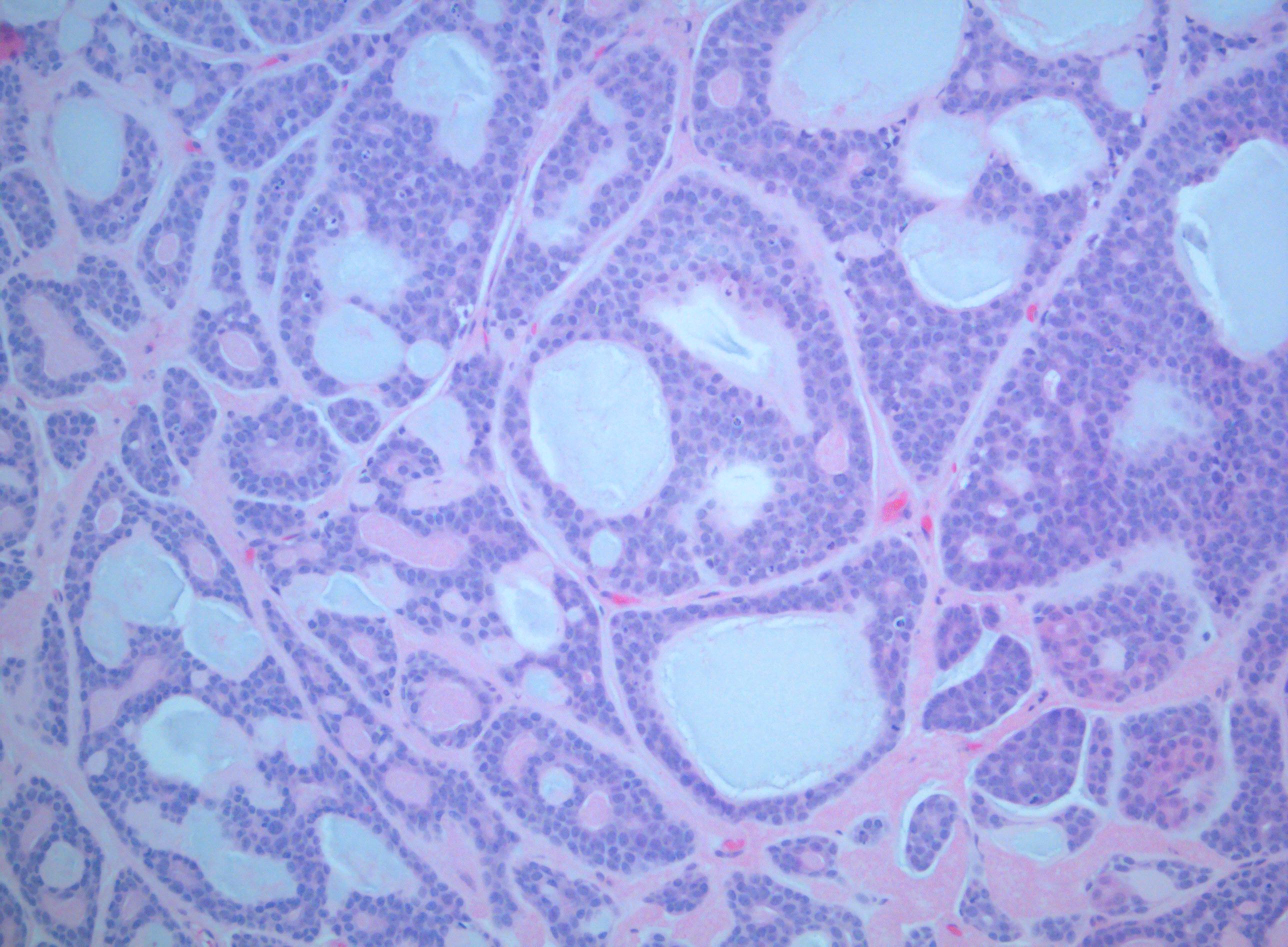 <p>Acinic Cell Carcinoma of the Palate</p>