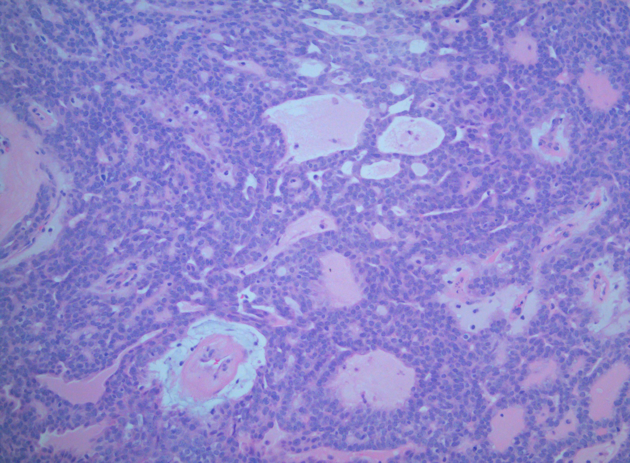 <p>Polymorphous Low-Grade Adenocarcinoma of the Palate</p>