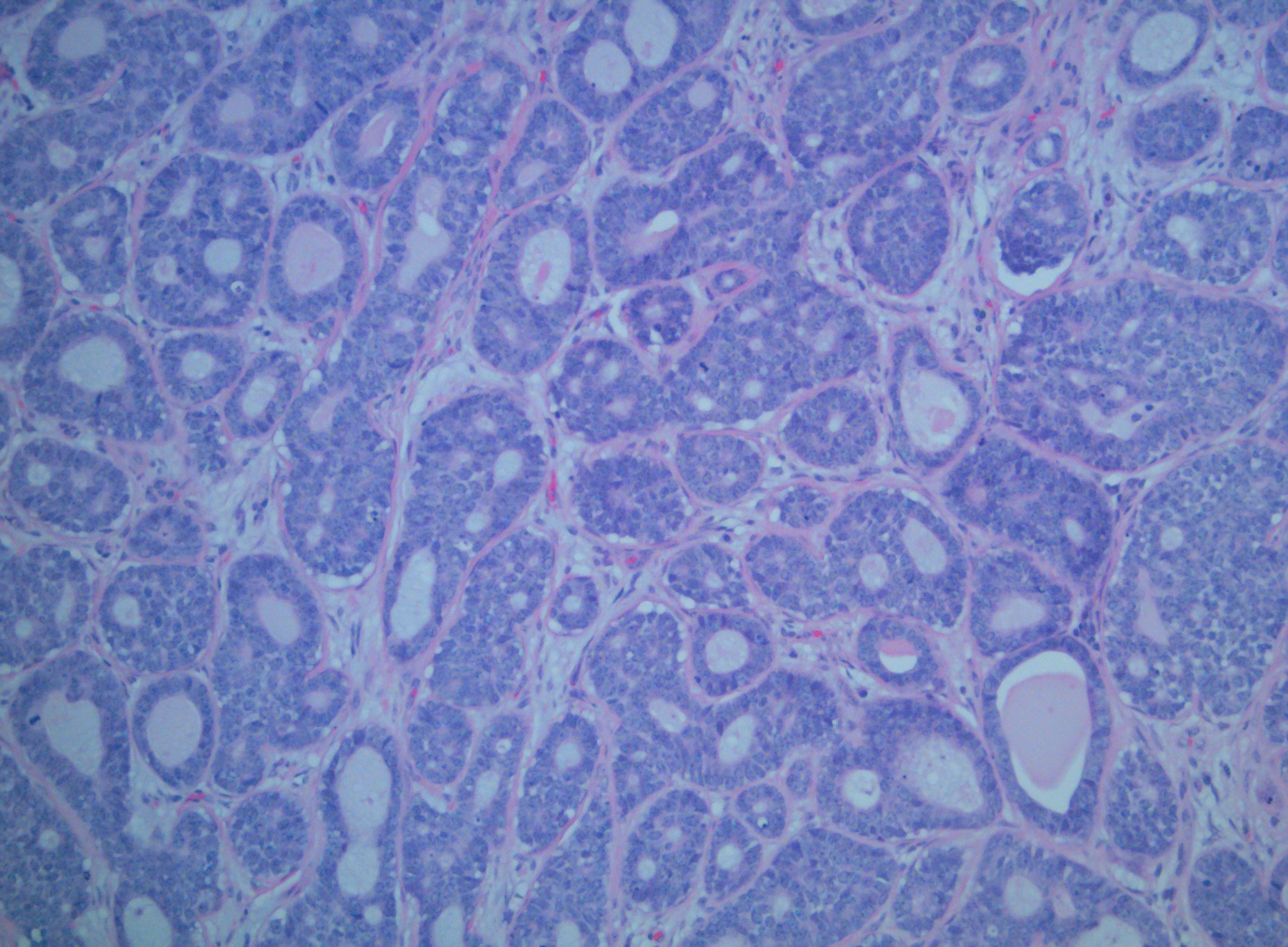 <p>Adenoid Cystic Carcinoma of the Palate</p>