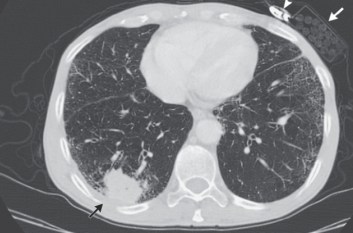 Squamous cell carcinoma of lung.