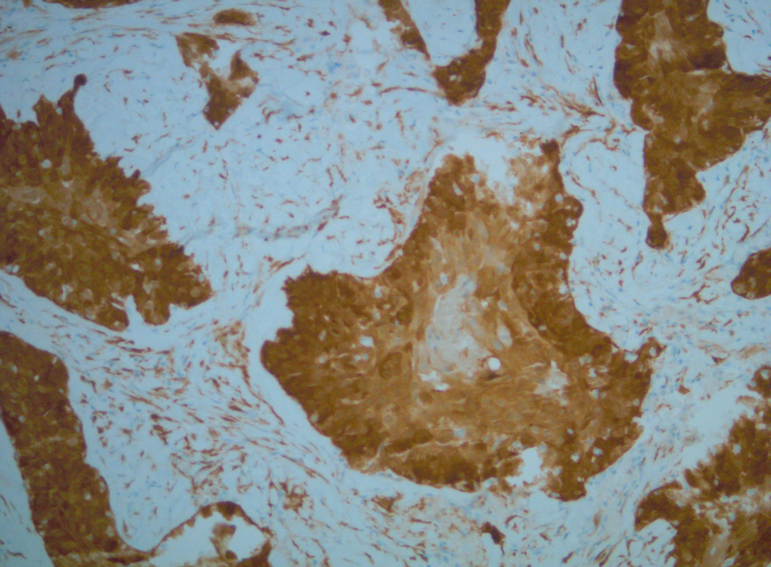 <p>HPV-Positive Squamous Cell Carcinoma of the Palate With P16 (+) Staining</p>