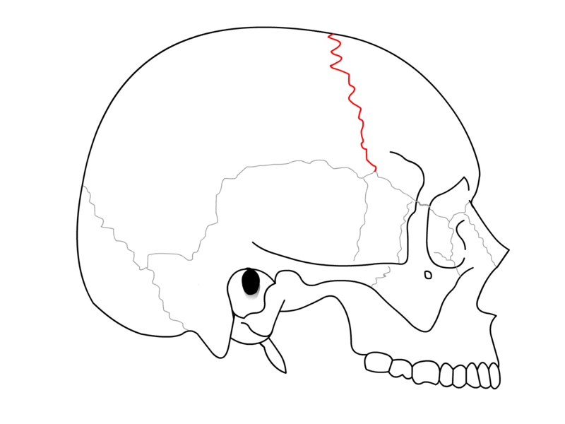 <p>Coronal Suture. This suture joins the frontal bone anteriorly with the skull's right and left parietal bones.</p>