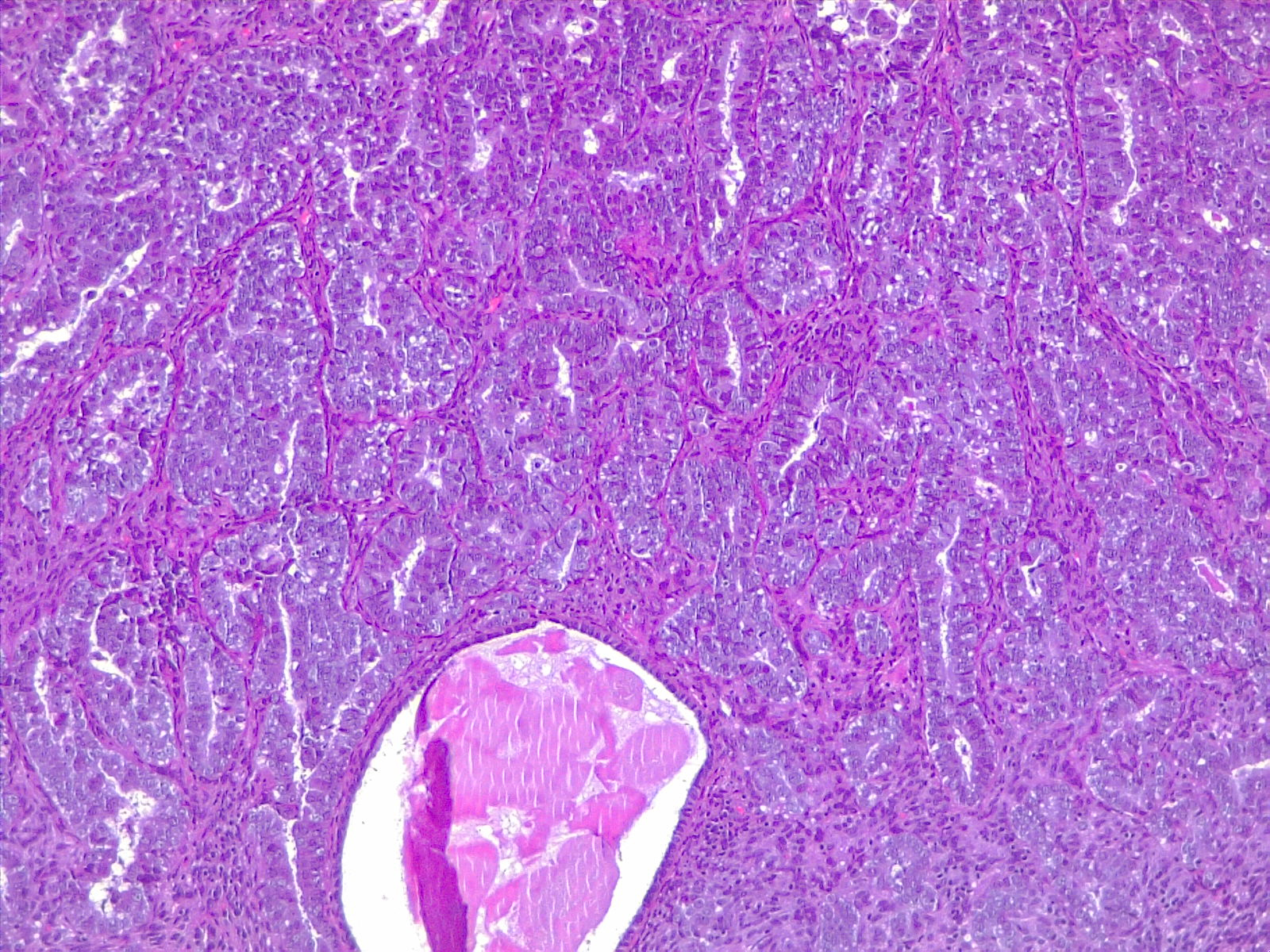 Uterus, endometrial carcinoma. 4x H/E