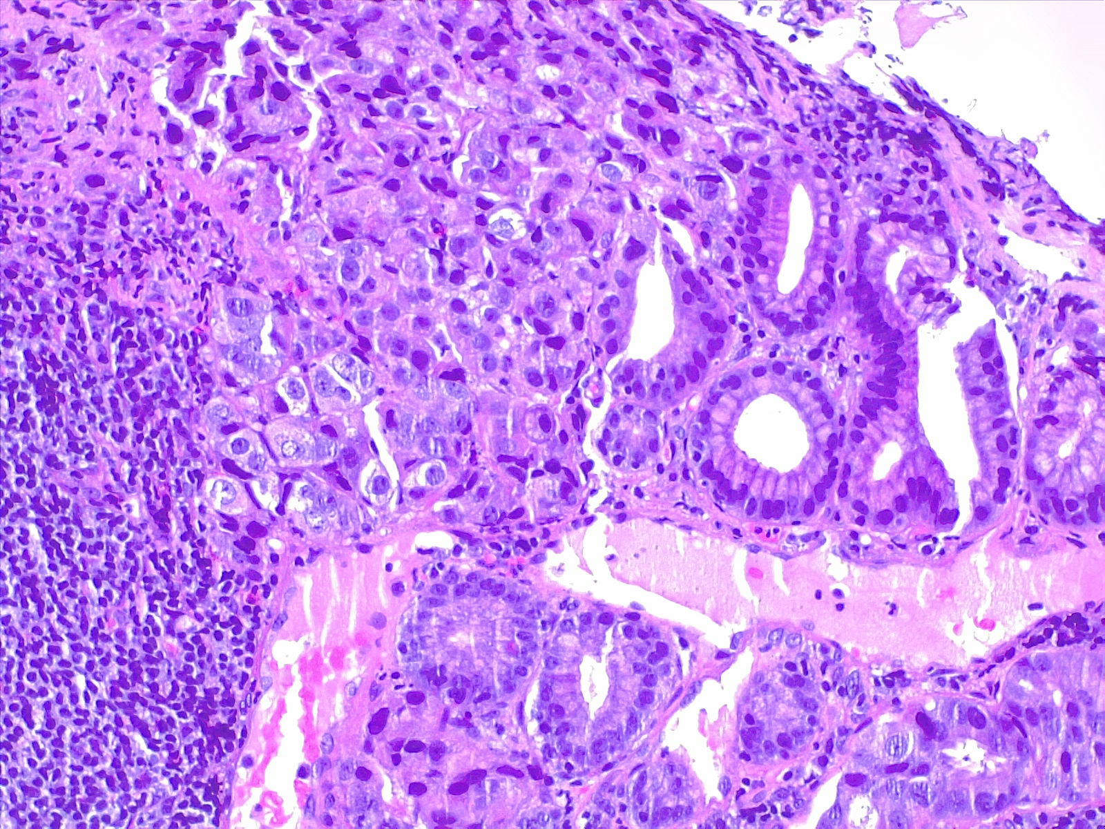 Gastric carcinoma, 10x H/E