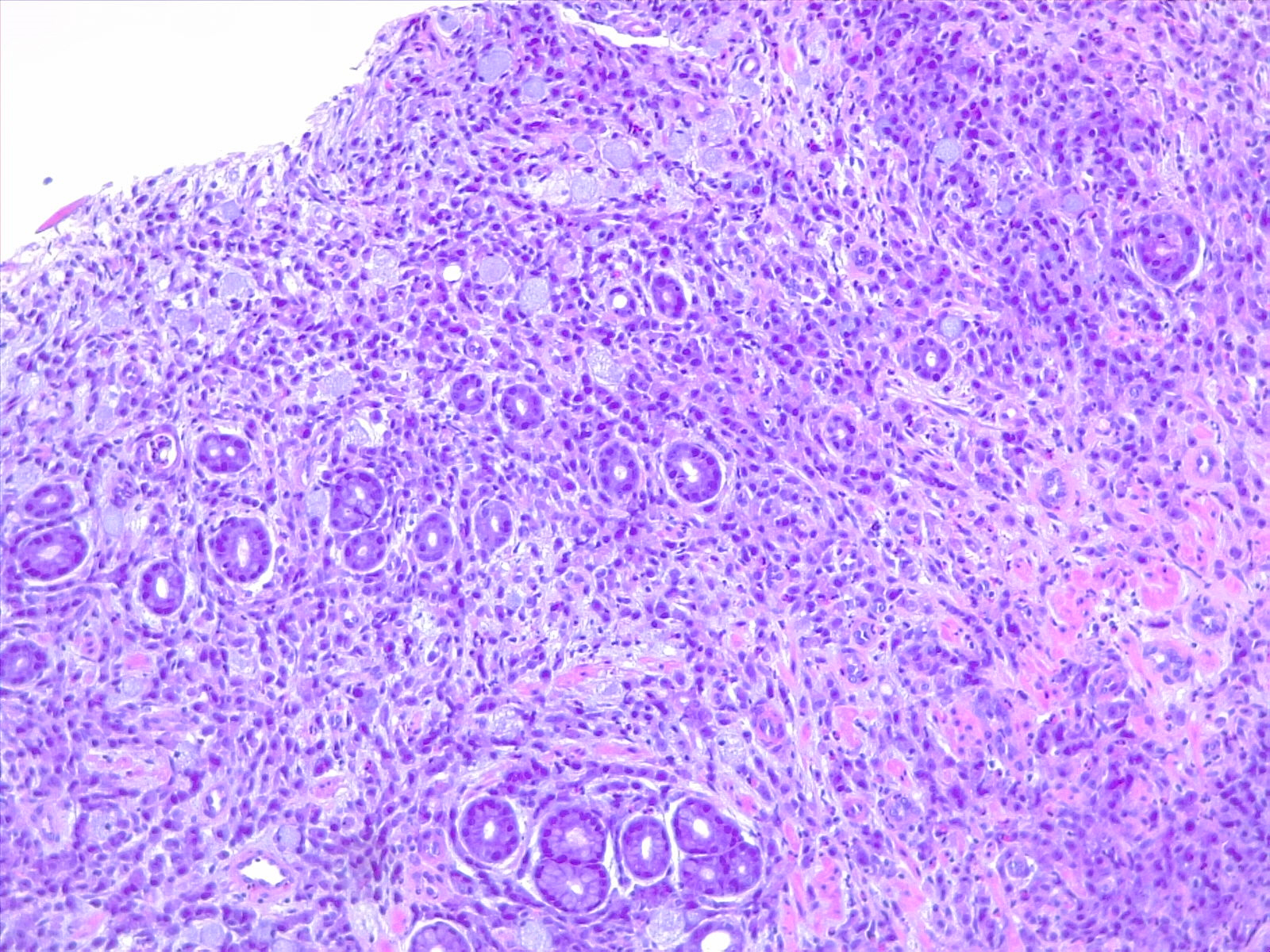 Signet ring carcinoma. 10x H/E