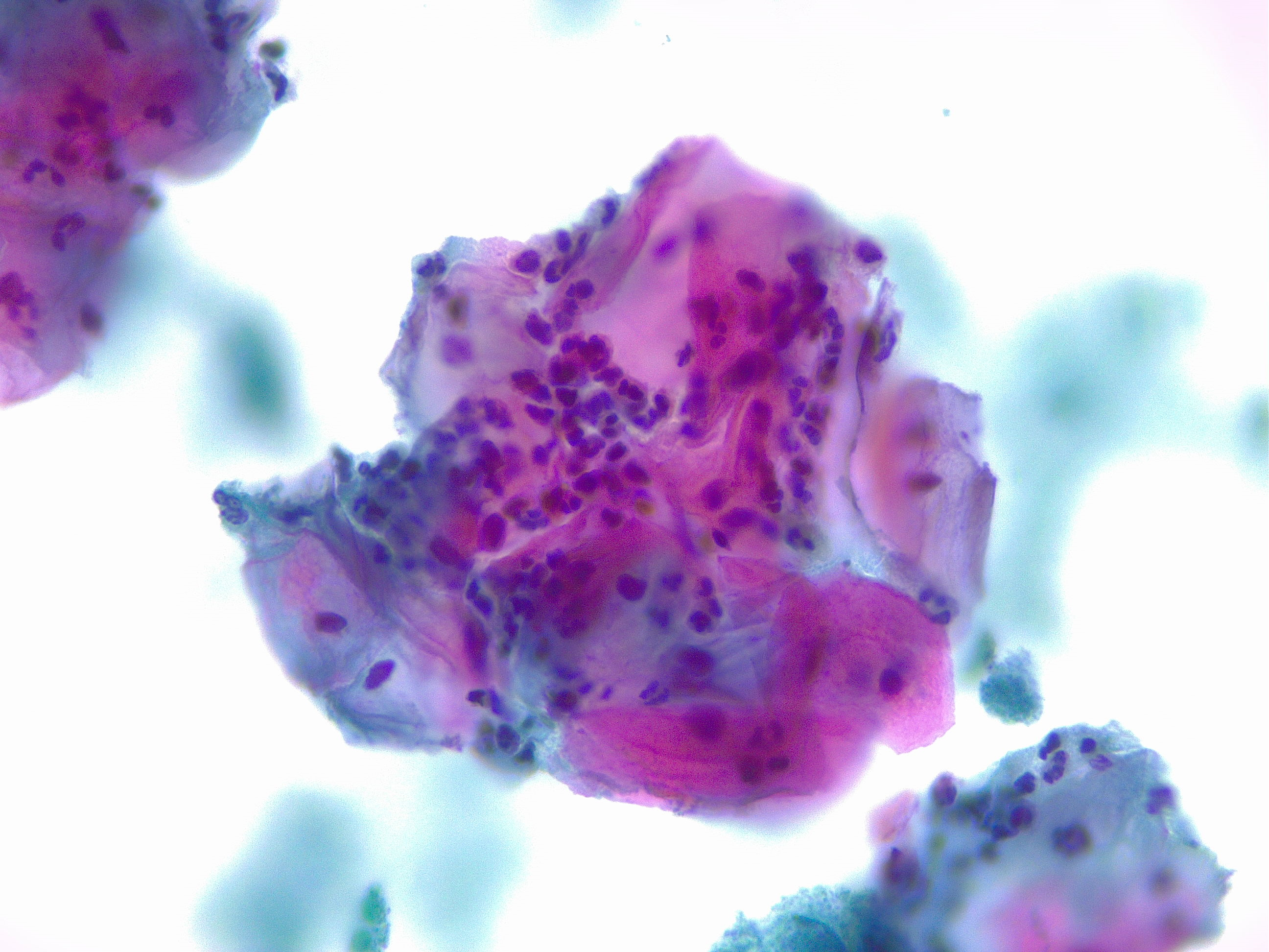 <p>Squamous Cells, Acute Inflammation. Cytology, papanicolaou stain &times;40&nbsp;magnification.</p>