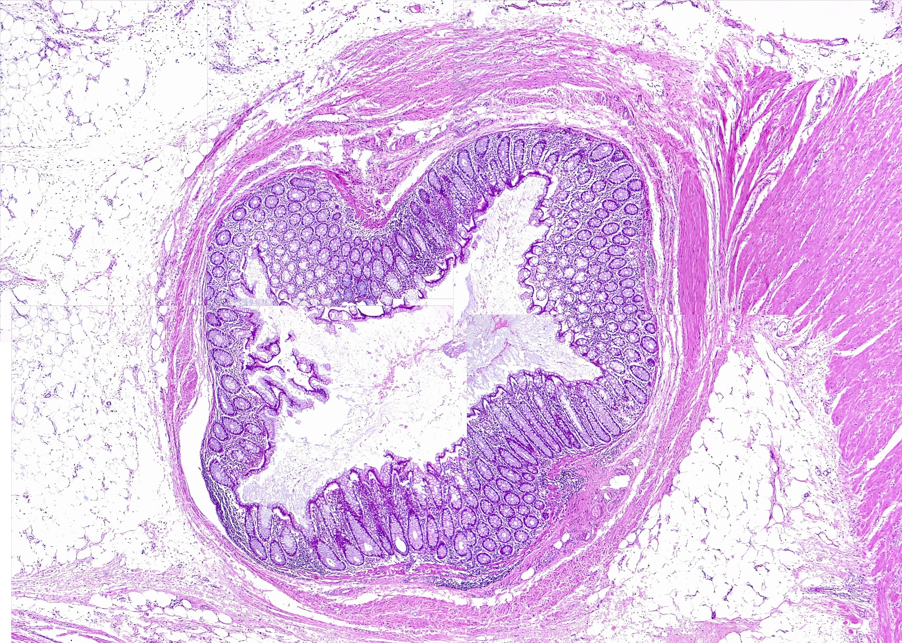 Colon, diverticulum. Diverticulosis. H/E 1x