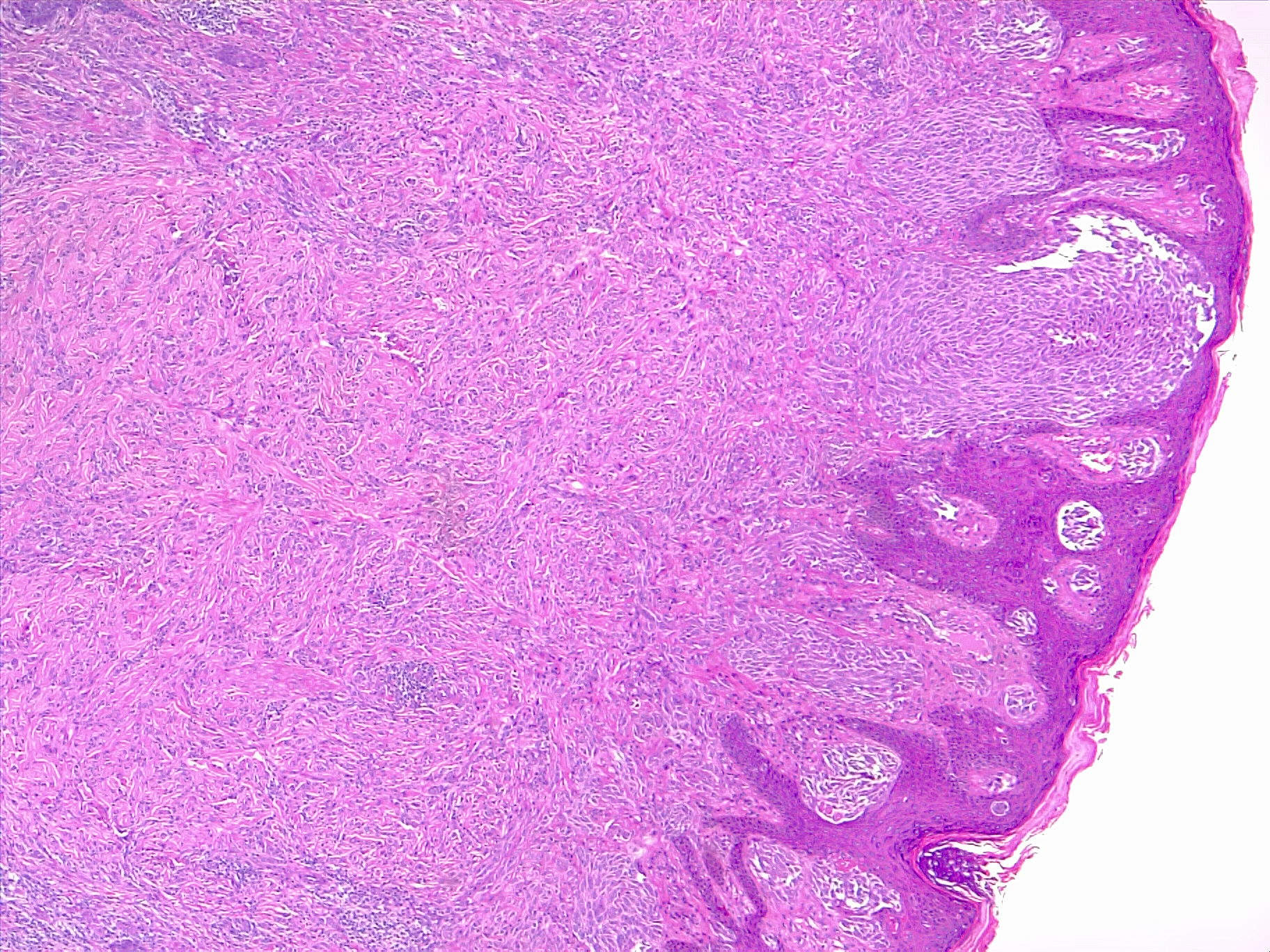 <p>Superficial Melanoma