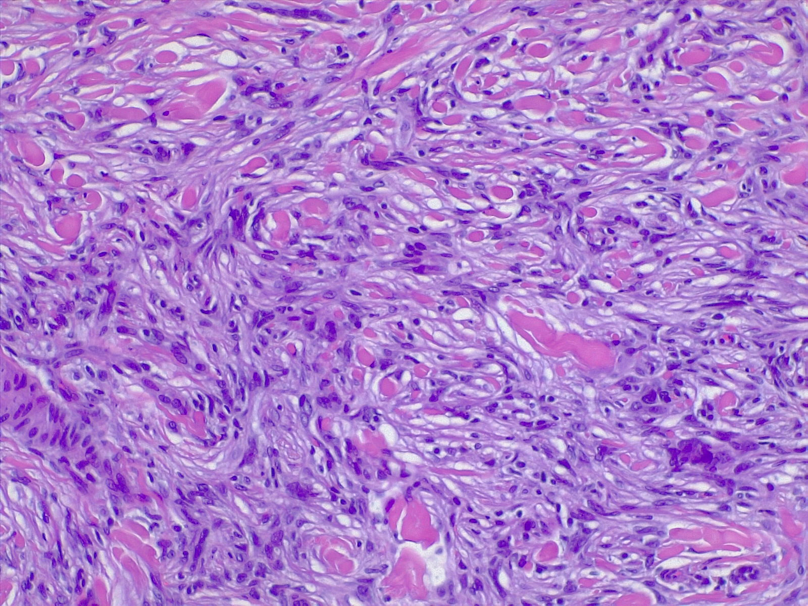 Dermatofibroma H/E 10x. Spindle cells entrapping collagen bundles.