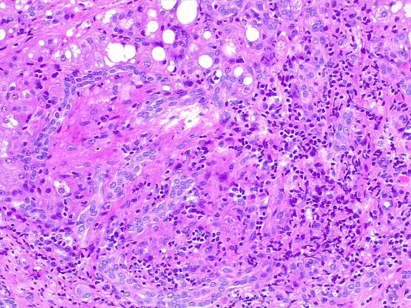 Chronic inflammation in a distorted portal space is a feature of chronic hepatitis. Liver biopsy H/E