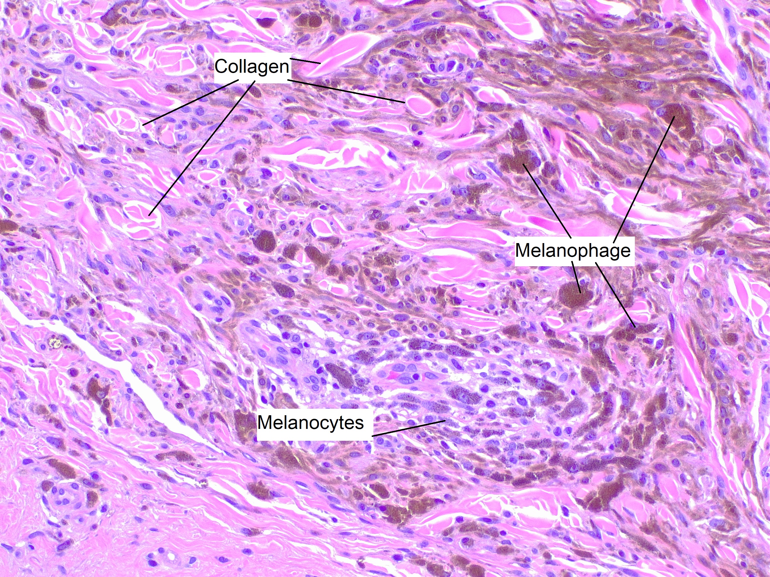 <p>Blue Nevus, H/E 20x