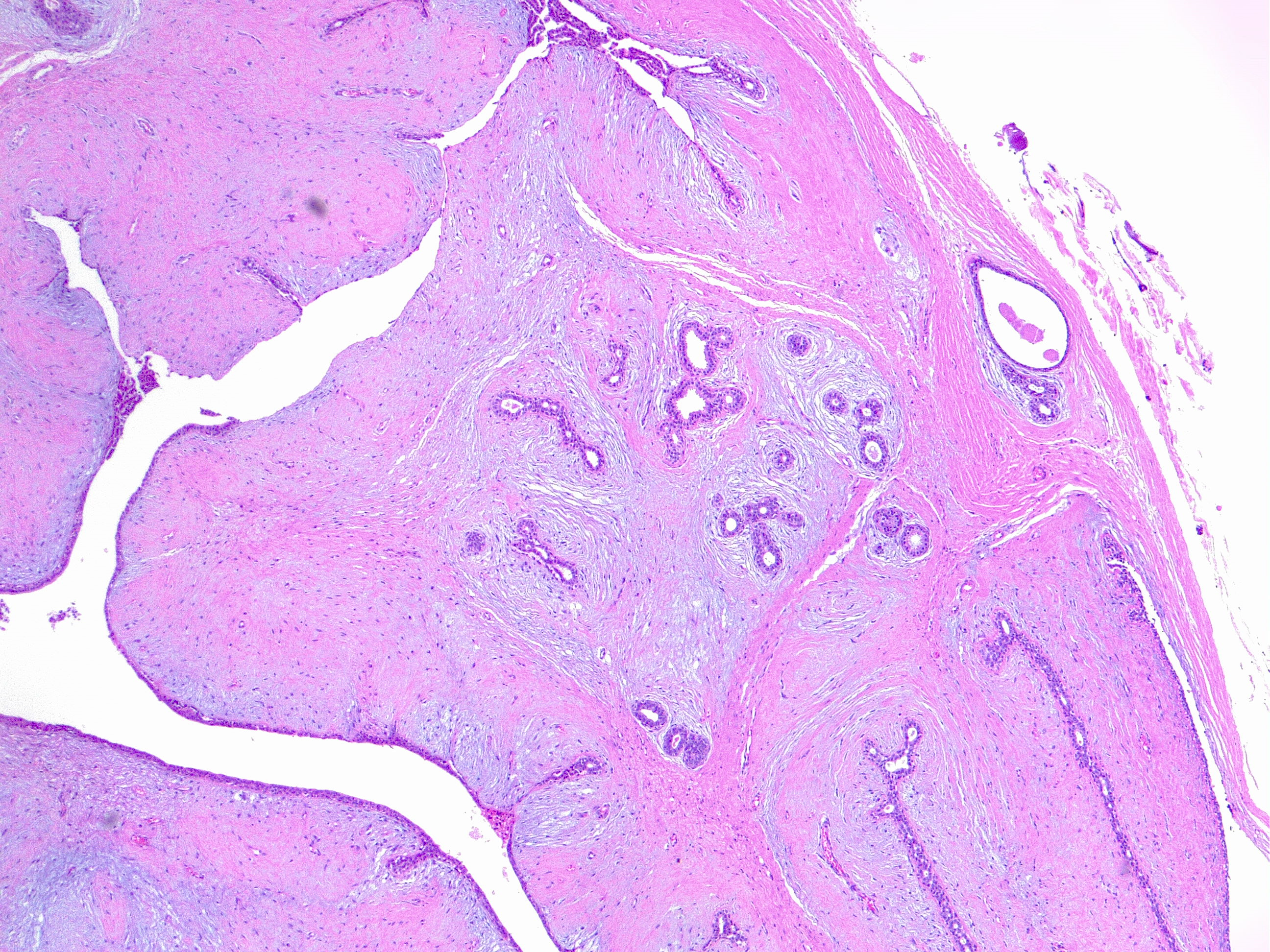 Phylloides tumor of the breast, benign. H/E 4x