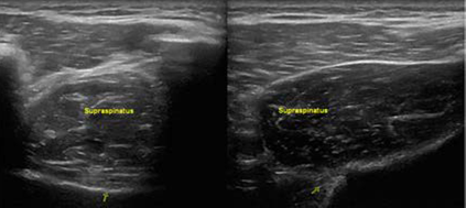 Ultrasound imaging of the supraspinatus muscle in short axis with evidence of atrophy on left and normal comparison on right.