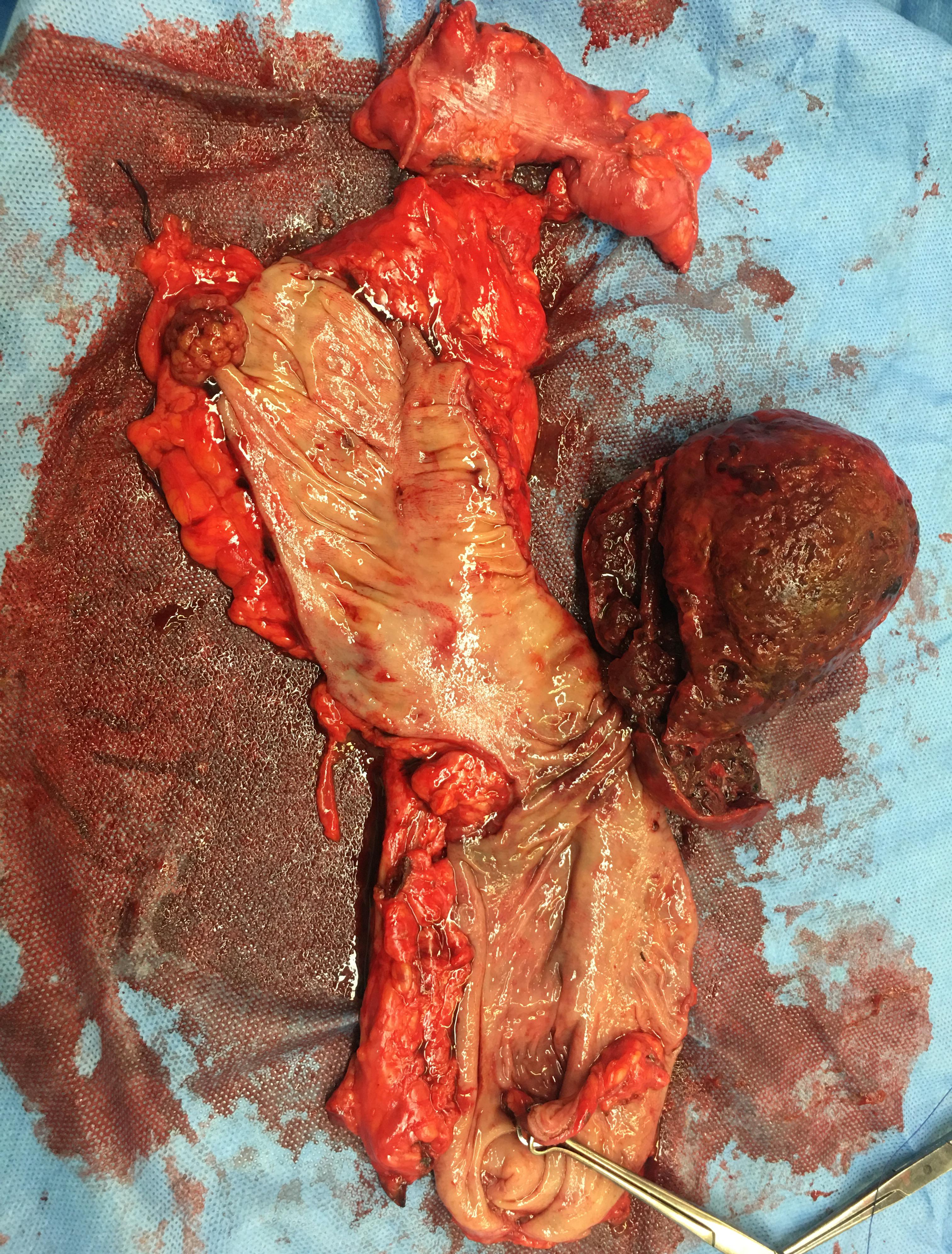 <p>Excision of Leiomyosarcoma of the Rectum