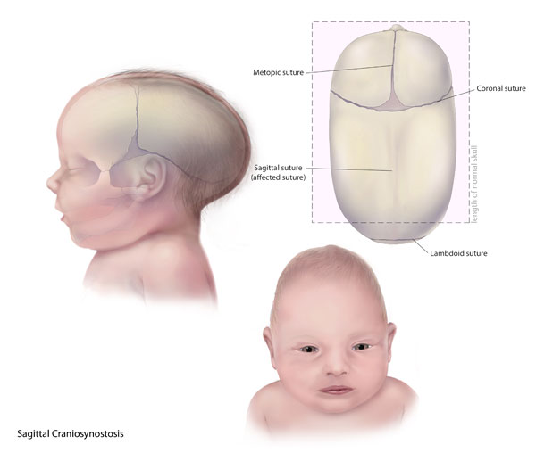 <p>Scaphocephaly