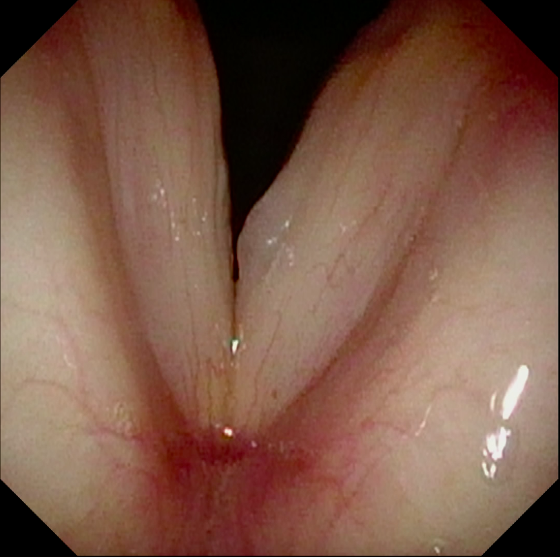 Vocal Fold Polyp