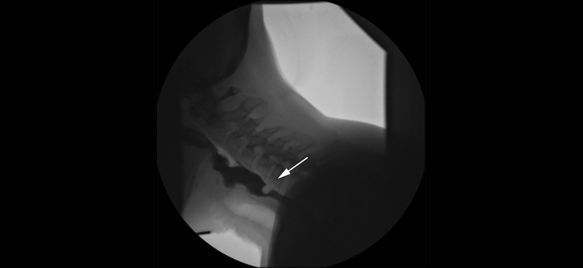 <p>Lateral Videofluoroscopic Swallowing Study