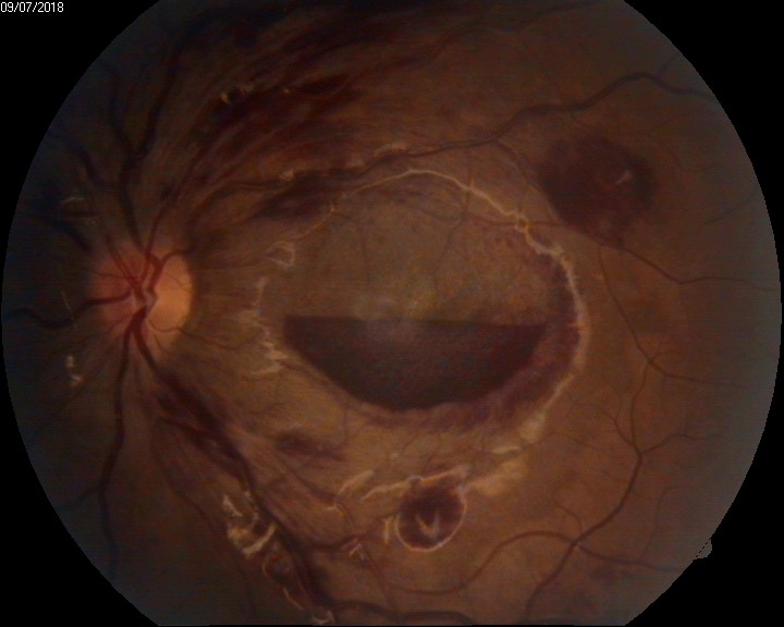 <p>Intraocular Hemorrhage, Anemic Retinopathy</p>