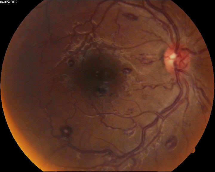 <p>Intraocular Hemorrhage, Roth Spots</p>