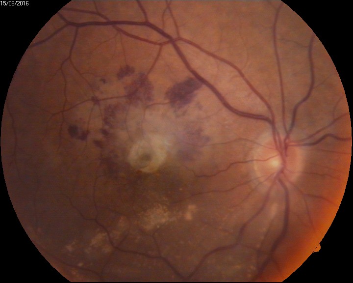 <p>Intraocular Hemorrhage&nbsp;on Funduscopy. This image shows a hemorrhagic choroidal neovascular membrane.</p>