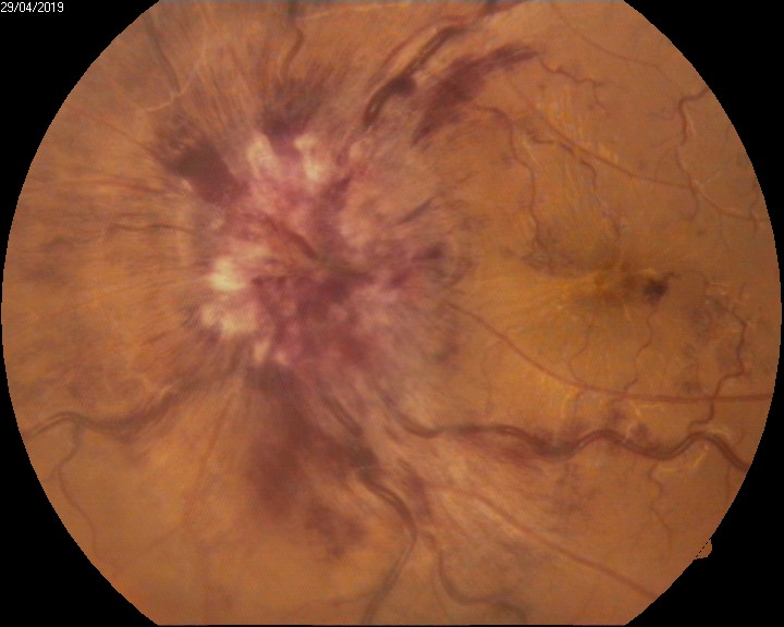 <p>Intraocular Hemorrhage, Disc Hemorrhage in Grade 4 Papilloedema</p>