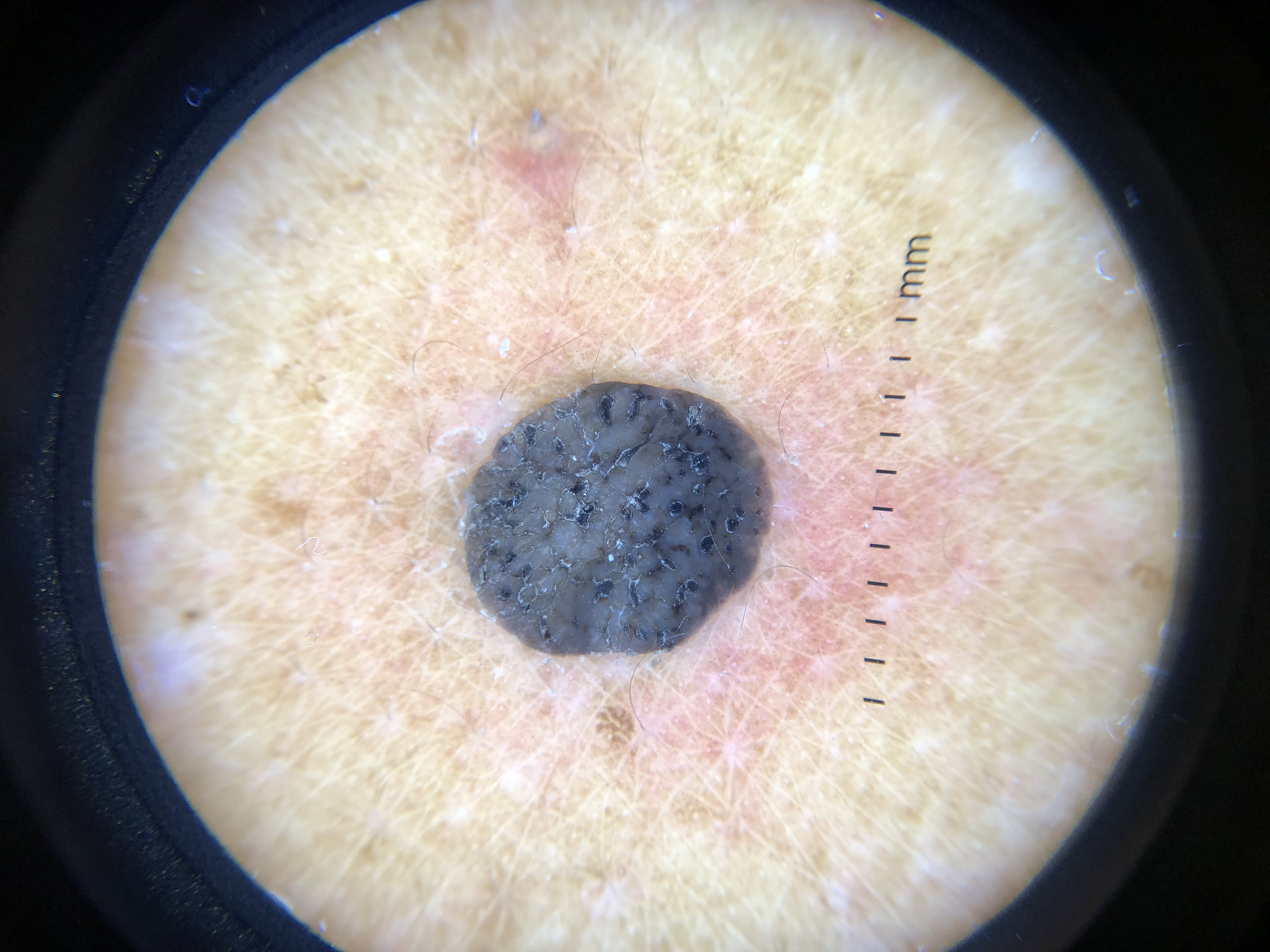 <p>Dermoscopy of Seborrheic Keratosis. Horny cysts, fissures, and ridges can be observed.</p>